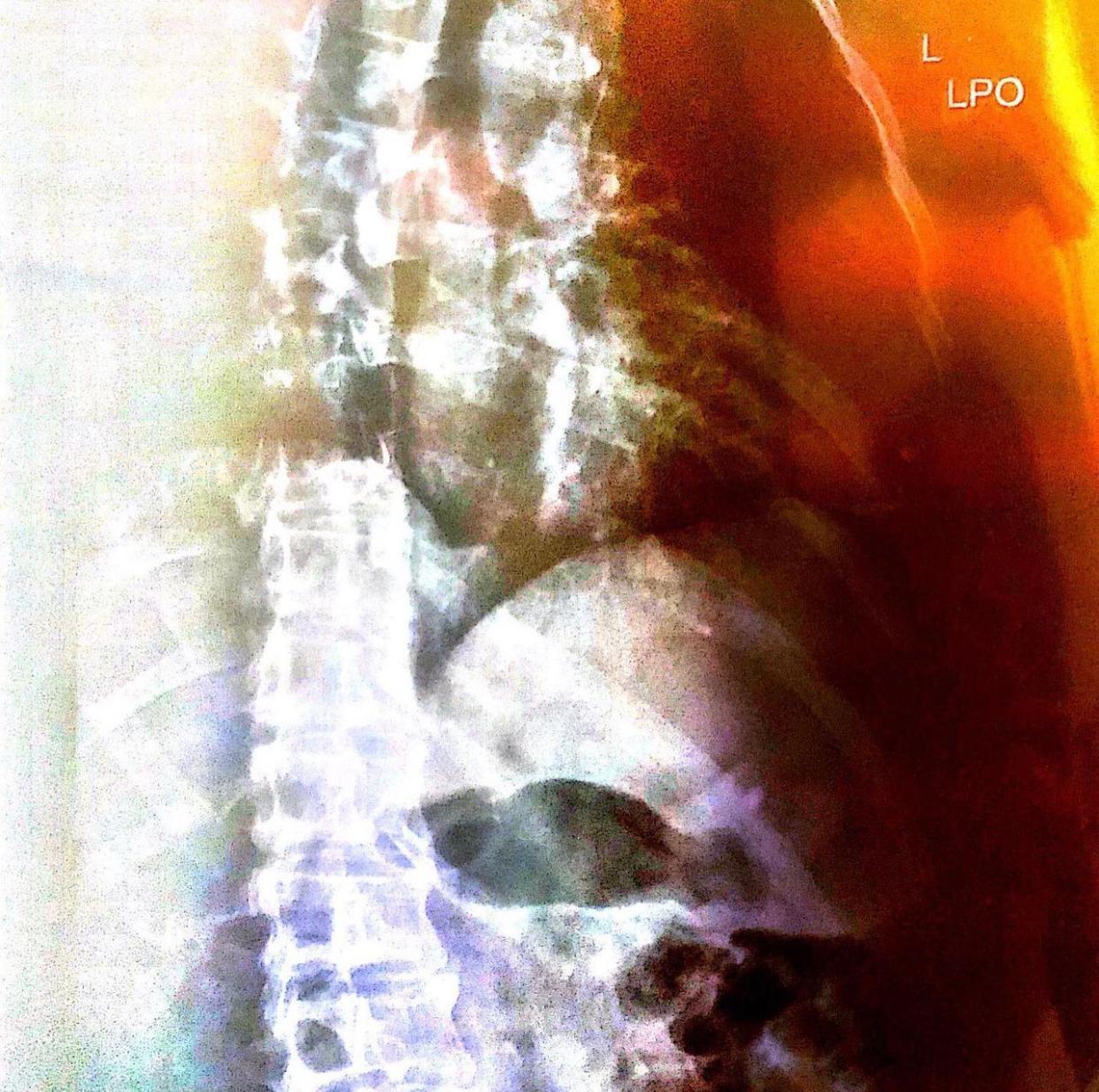 Jarvis Cocker在社交平台公開X光片。