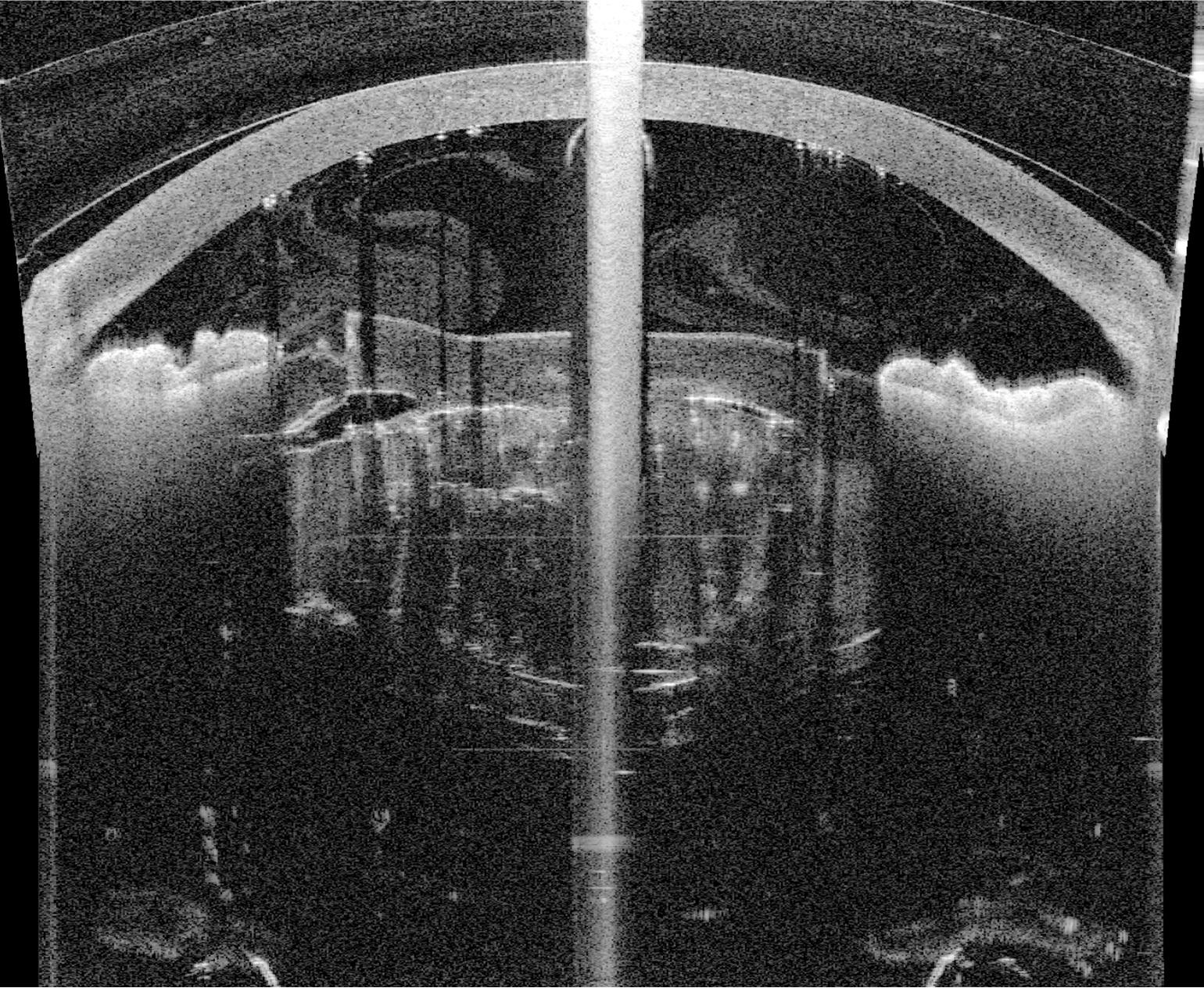 飛秒激光白內障手術
