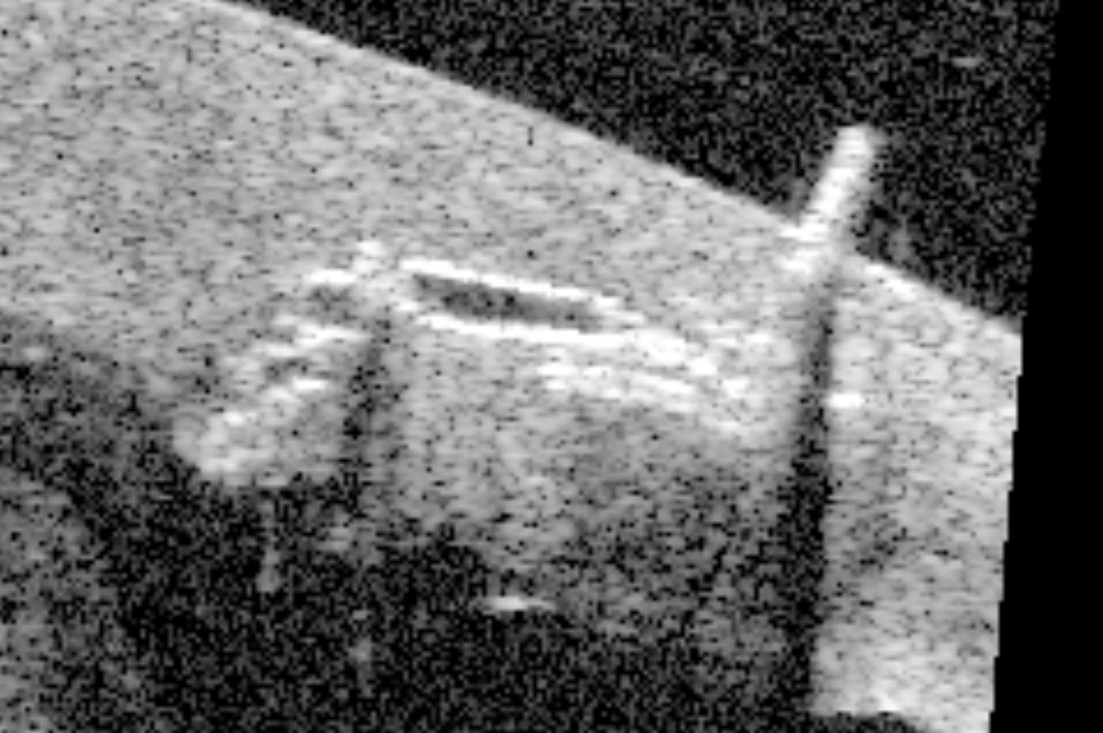 飛秒激光白內障手術