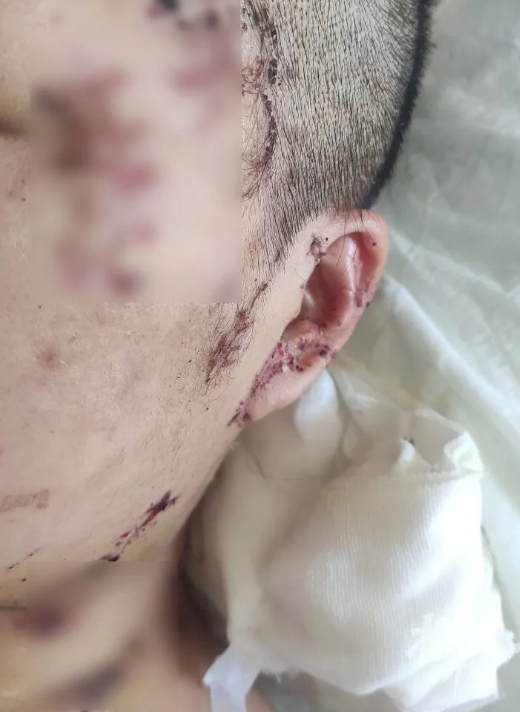 醫院診斷書顯示,黃女的頭頸部、左耳廓、右肘外側、左手掌和腹部等位置有多處傷口,傷口見活動性出血。她在醫院搶救時,院方曾下達危重通知。