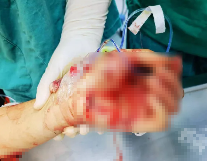 醫院診斷書顯示,黃女的頭頸部、左耳廓、右肘外側、左手掌和腹部等位置有多處傷口,傷口見活動性出血。她在醫院搶救時,院方曾下達危重通知。