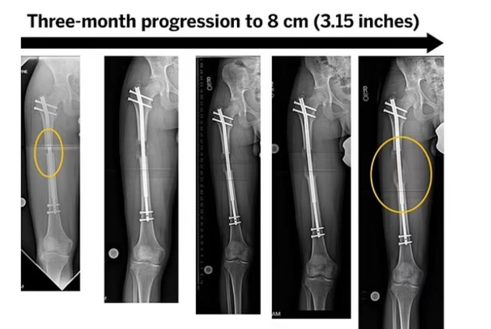 斷骨增高手術示意圖。(互聯網)