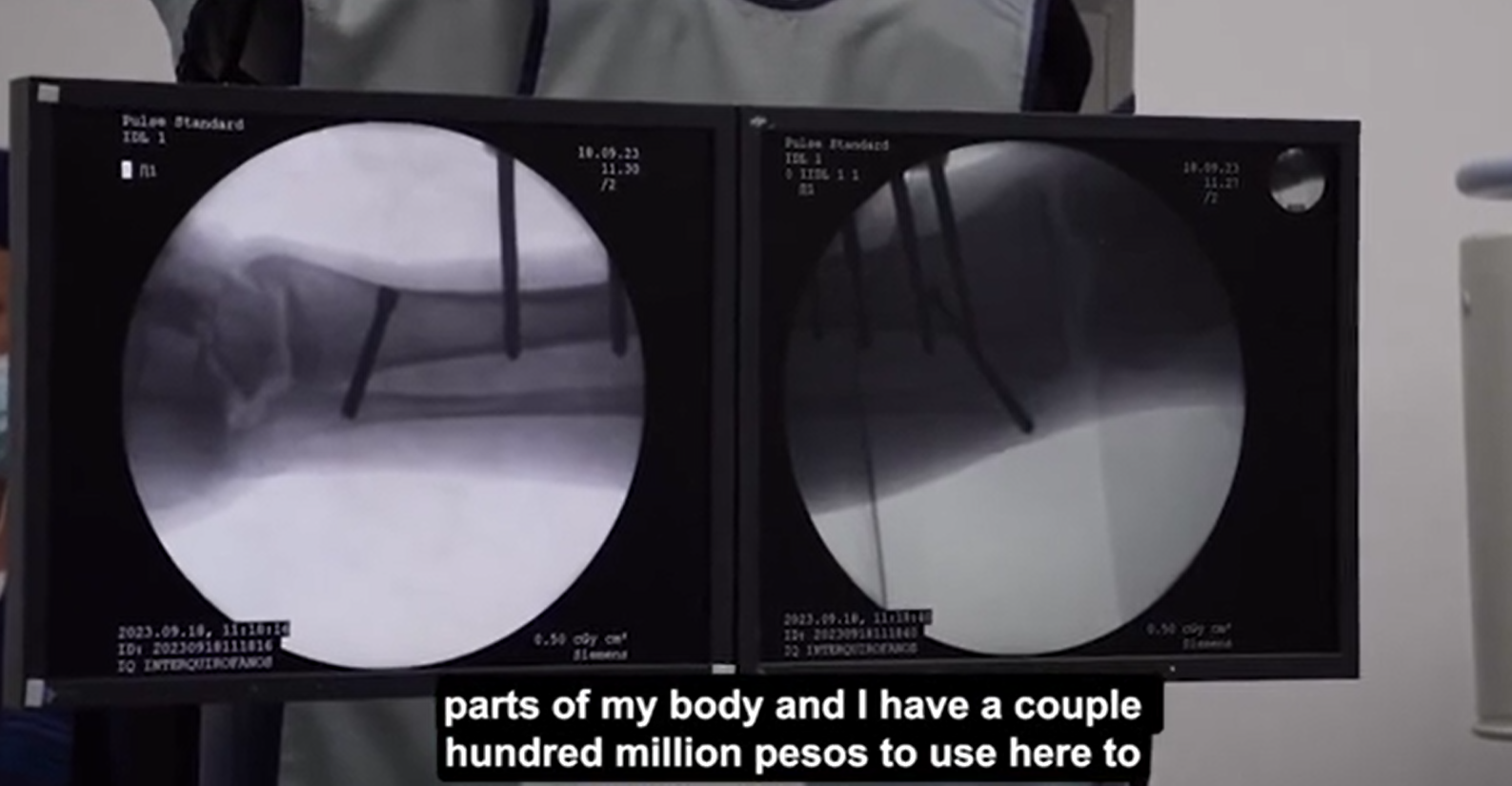 科西奧接受了增高手術。(互聯網)