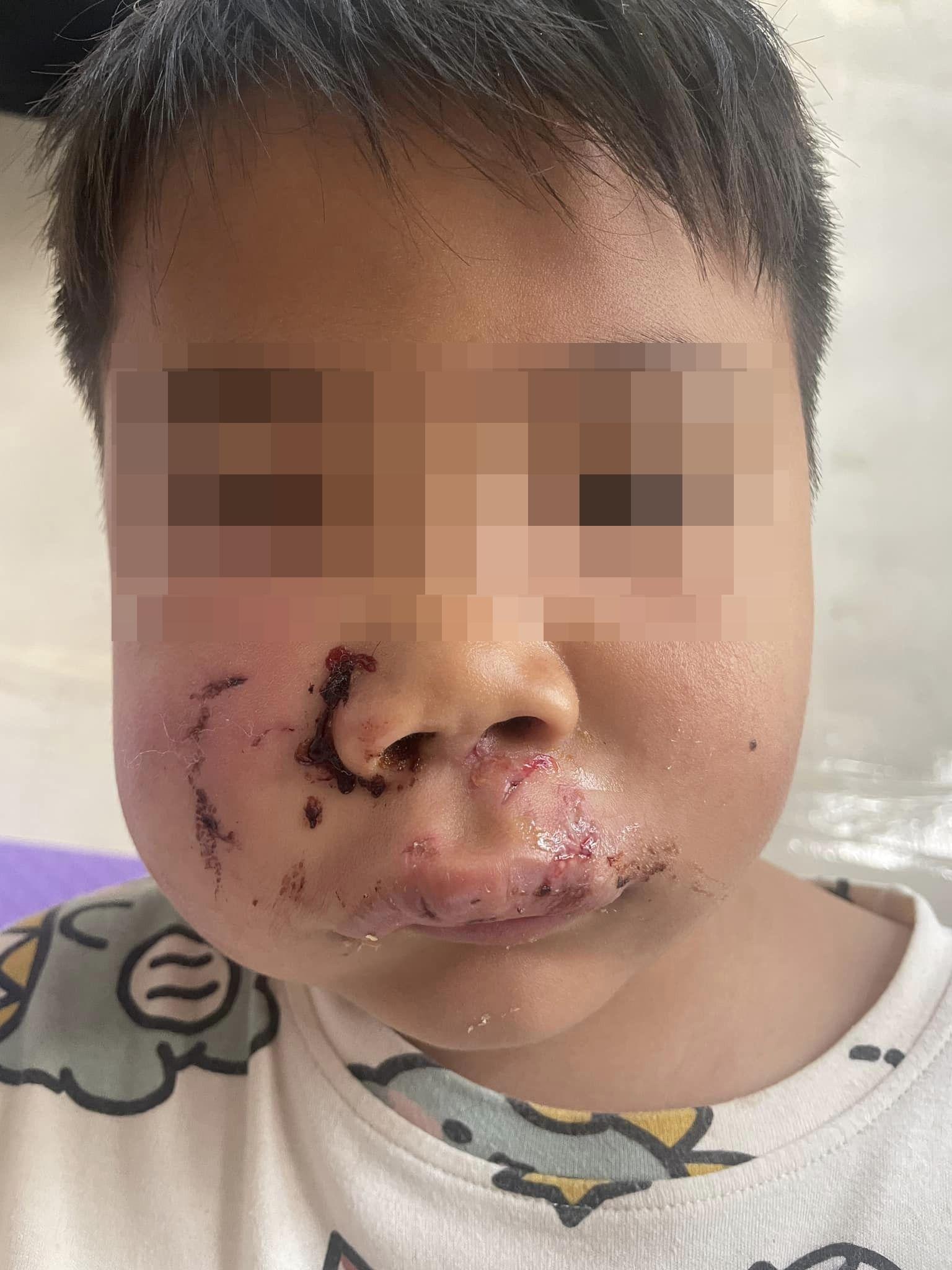 男童母周三在Facebook群組「荃灣友」發文,指其7歲兒子於荃灣沙咀道附近,被一隻黑色唐狗咬傷面頰。