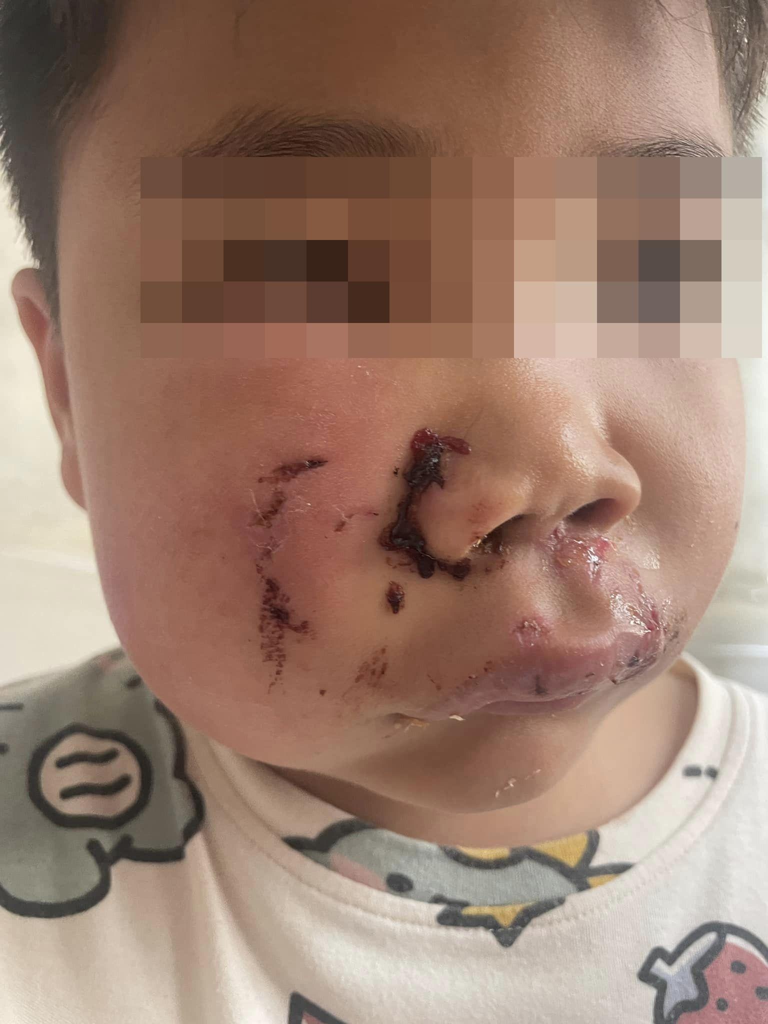 男童母周三在Facebook群組「荃灣友」發文,指其7歲兒子於荃灣沙咀道附近,被一隻黑色唐狗咬傷面頰。