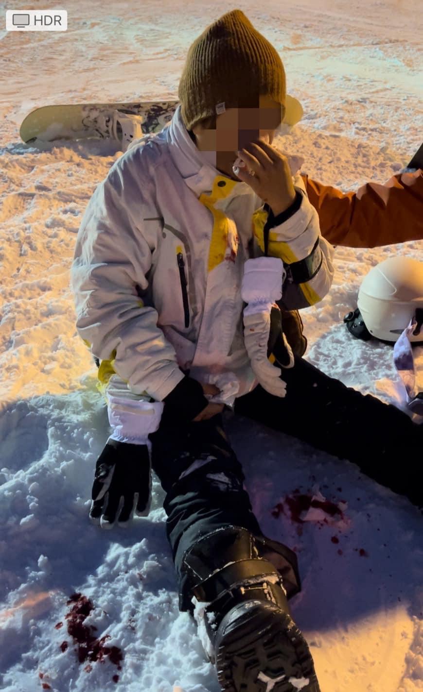 女事主被撞後鼻子「大噴血」。(FB SNOWKON滑雪控)