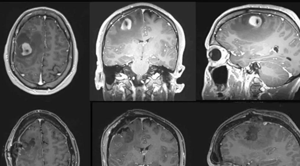 醫生替諾倫切除腦瘤(下圖)。(互聯網)
