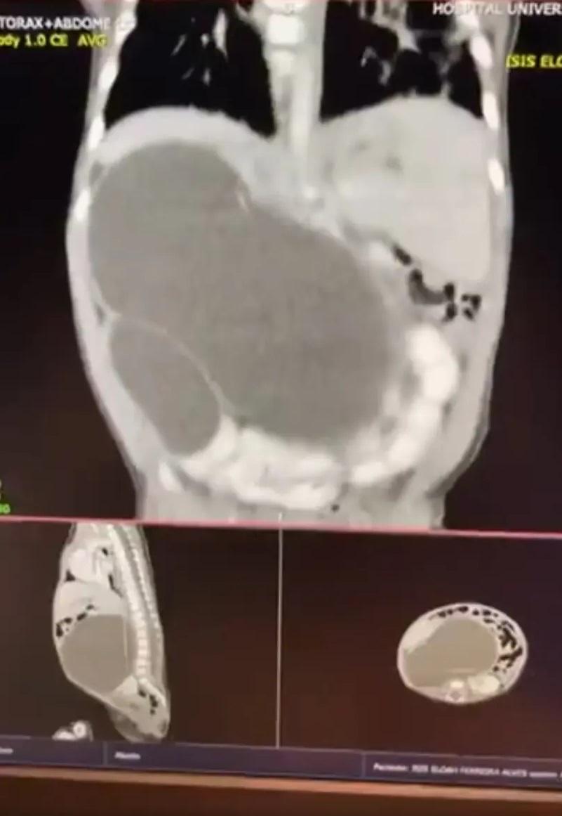 掃描檢查顯示,女嬰天生有4個腎臟。(互聯網)