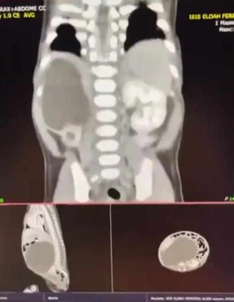 掃描檢查顯示,女嬰天生有4個腎臟。(互聯網)