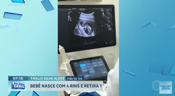 塔利亞產檢時發現胎兒腎臟發育異常。(互聯網)