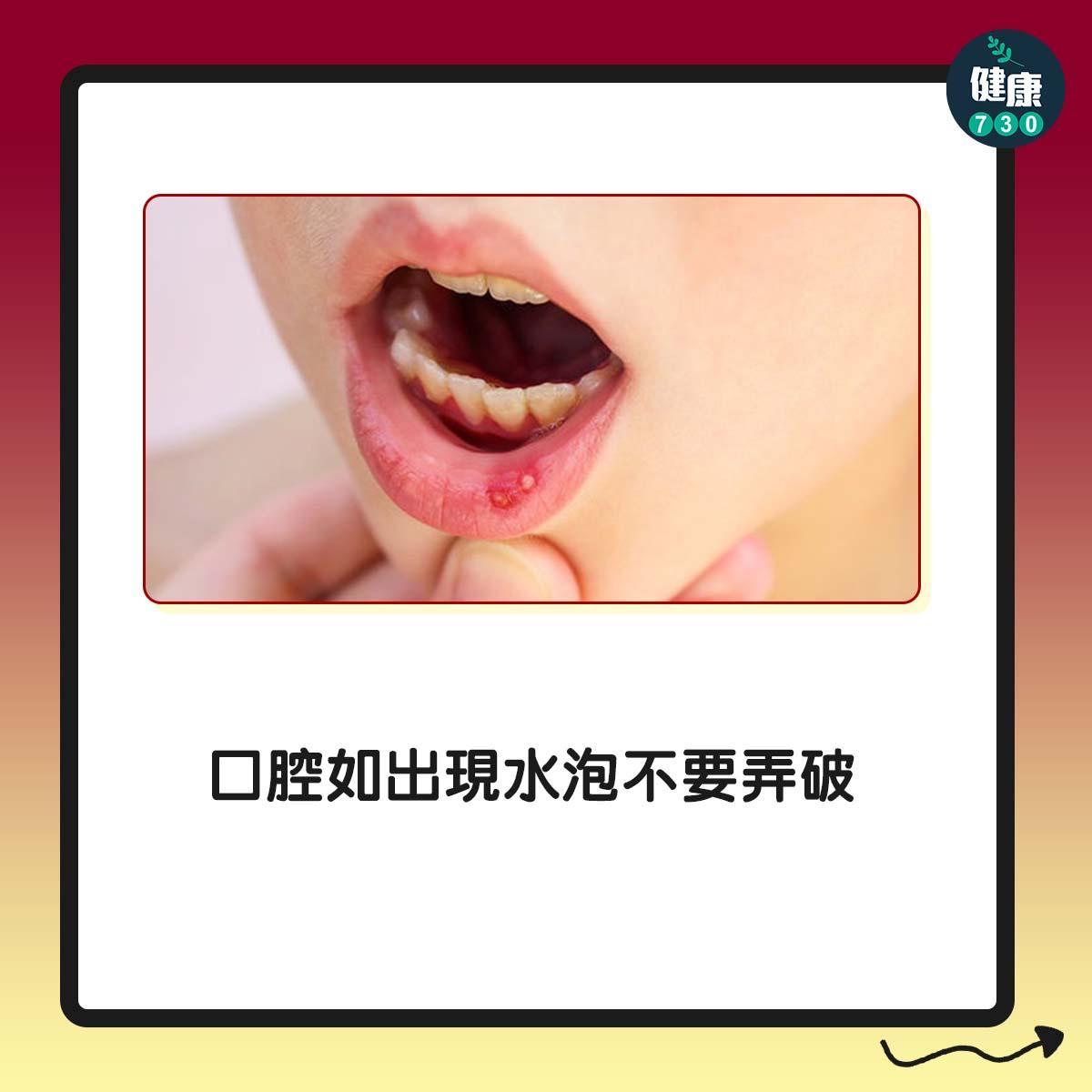 打邊爐易生痱滋及灼傷點算好?5大食火鍋注意事項(am730製圖)