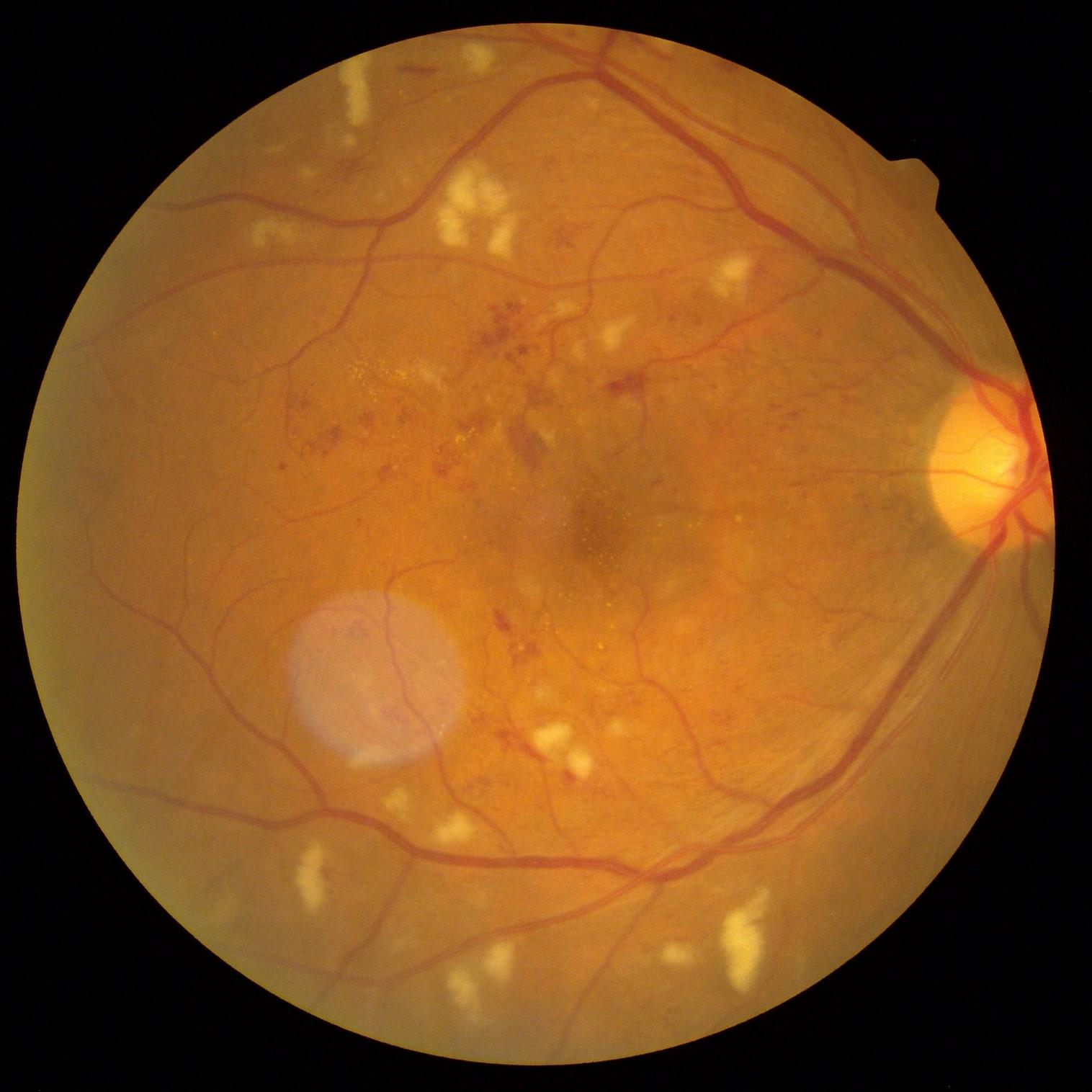 右眼中度至重度非增殖性糖尿病視網膜病變。