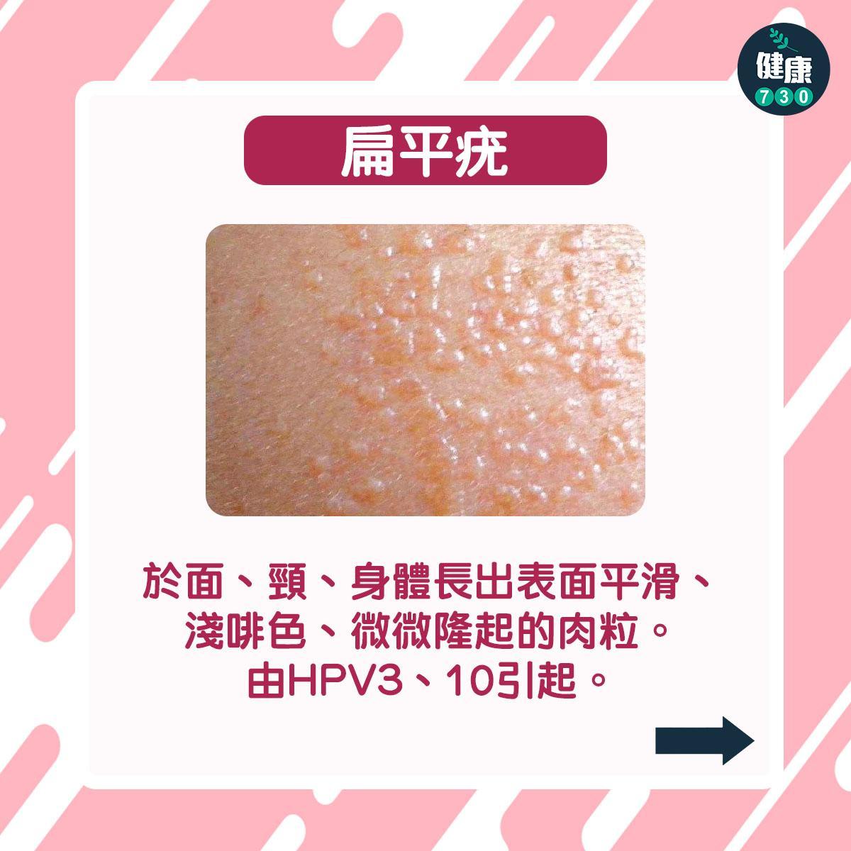 HPV病毒或會引致疣及癌症等。(am730製圖)