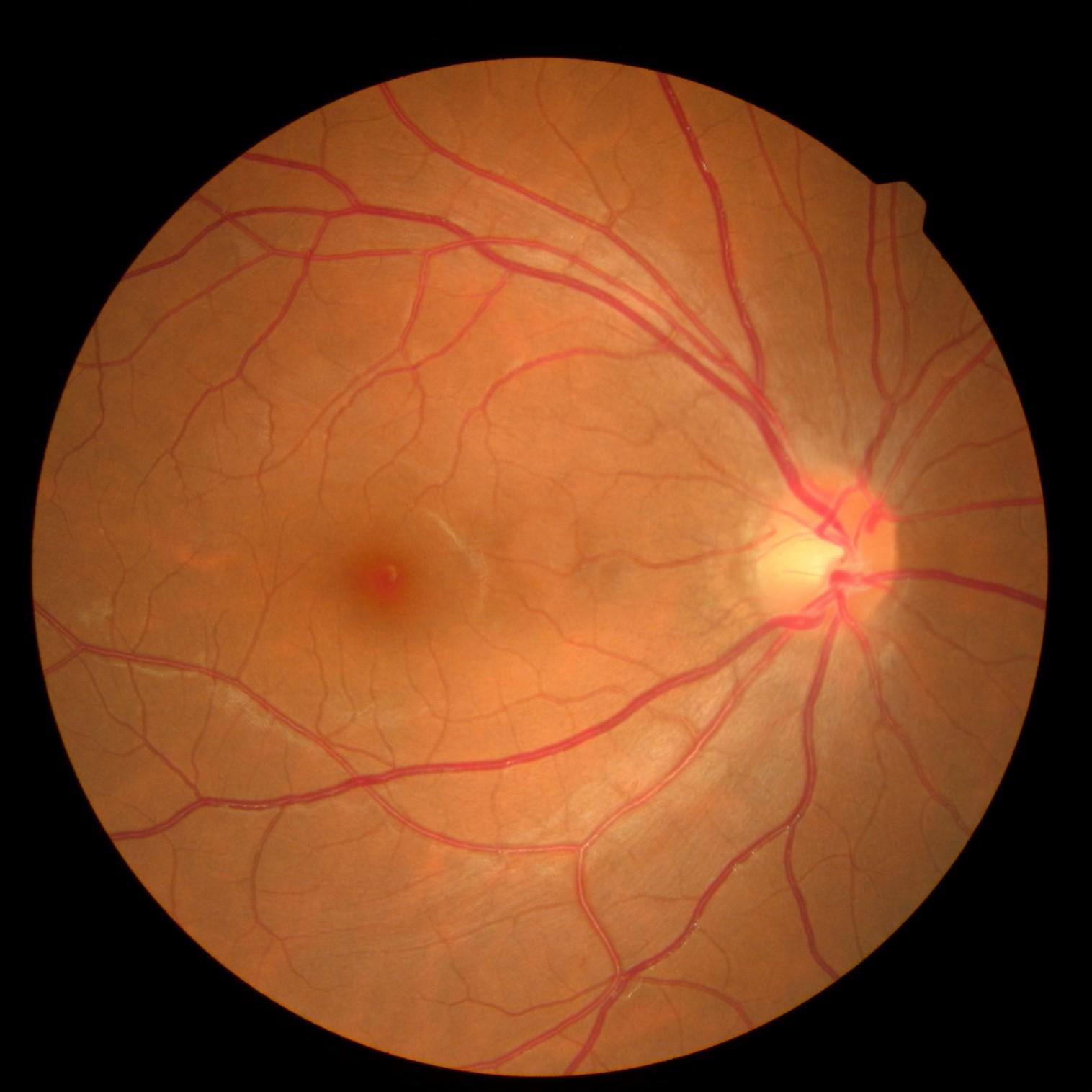 正常的右眼視網膜與黃斑點。