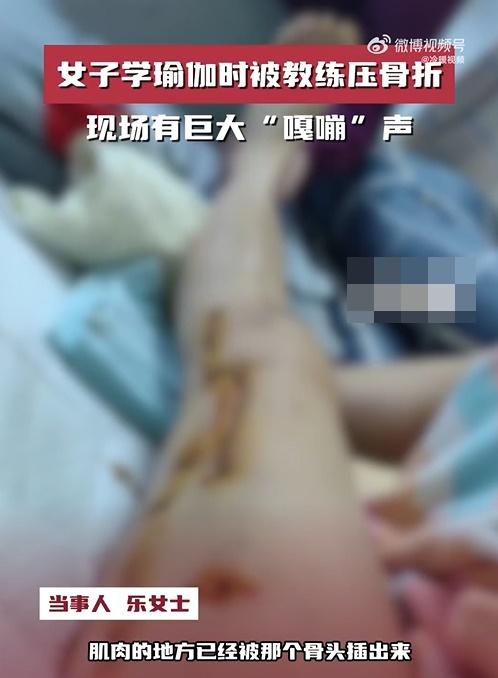 樂女士:「等我反應過來的時候,我的腿已經萎縮了……然後那個骨頭就插出來了。」(微博)