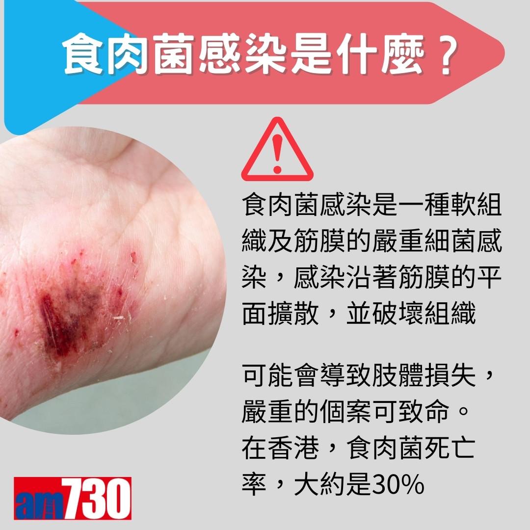 食肉菌症狀、來源及治療方法,嚴重感染需截肢?(am730製圖)