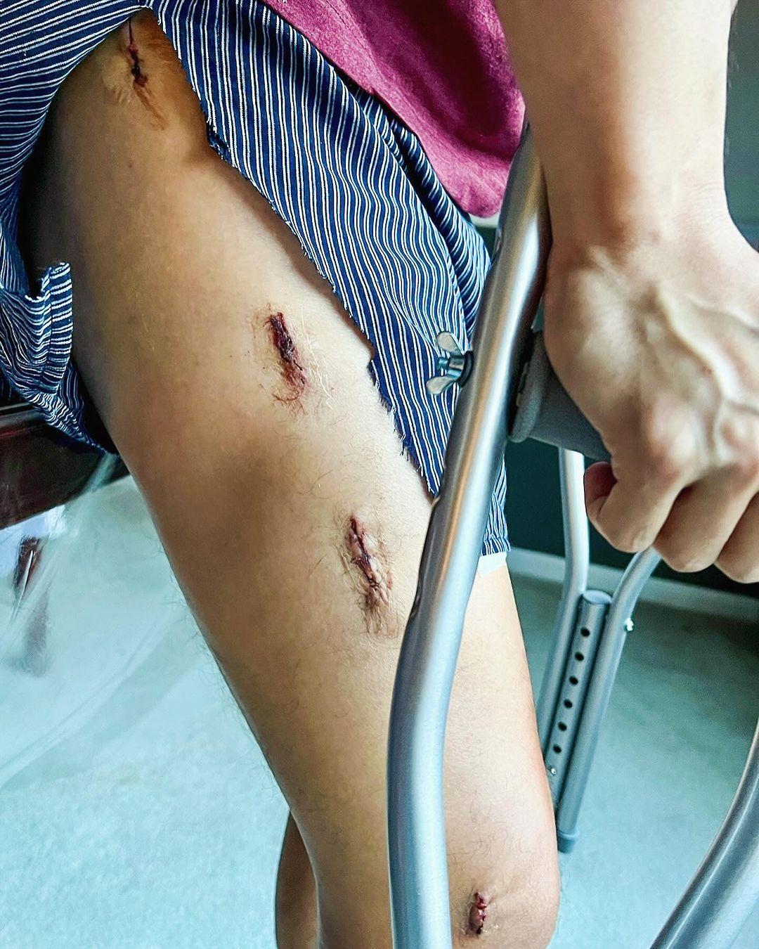 麥大力出PO自爆喺美國滑雪期間意外斷骨,傷勢嚴重。