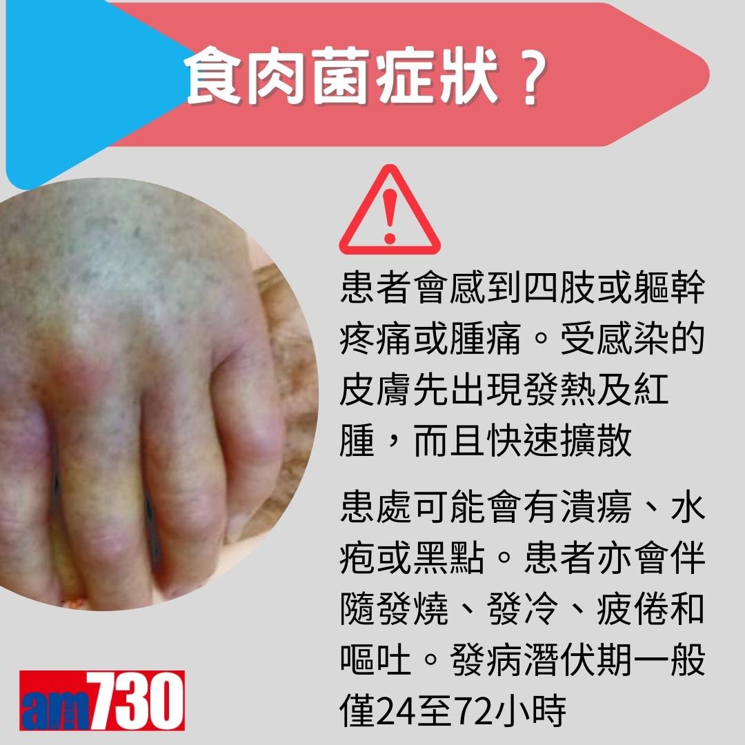 食肉菌症狀、來源及治療方法,嚴重感染需截肢?(am730製圖)