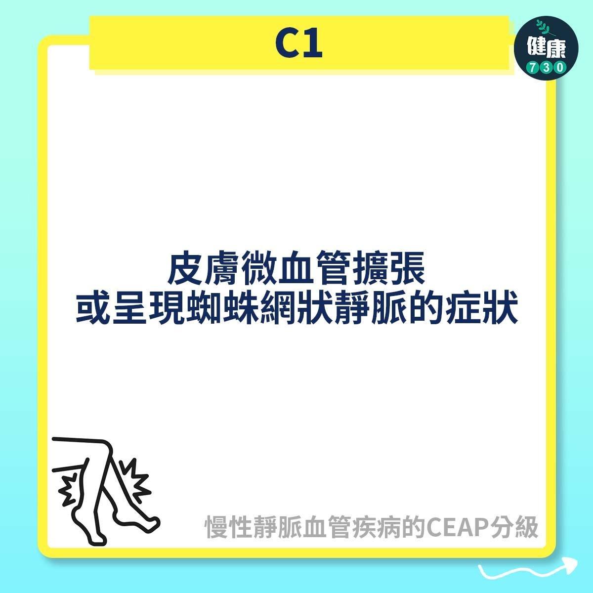 慢性靜脈血管疾病的CEAP分級,C2屬靜脈曲張(am730製圖)