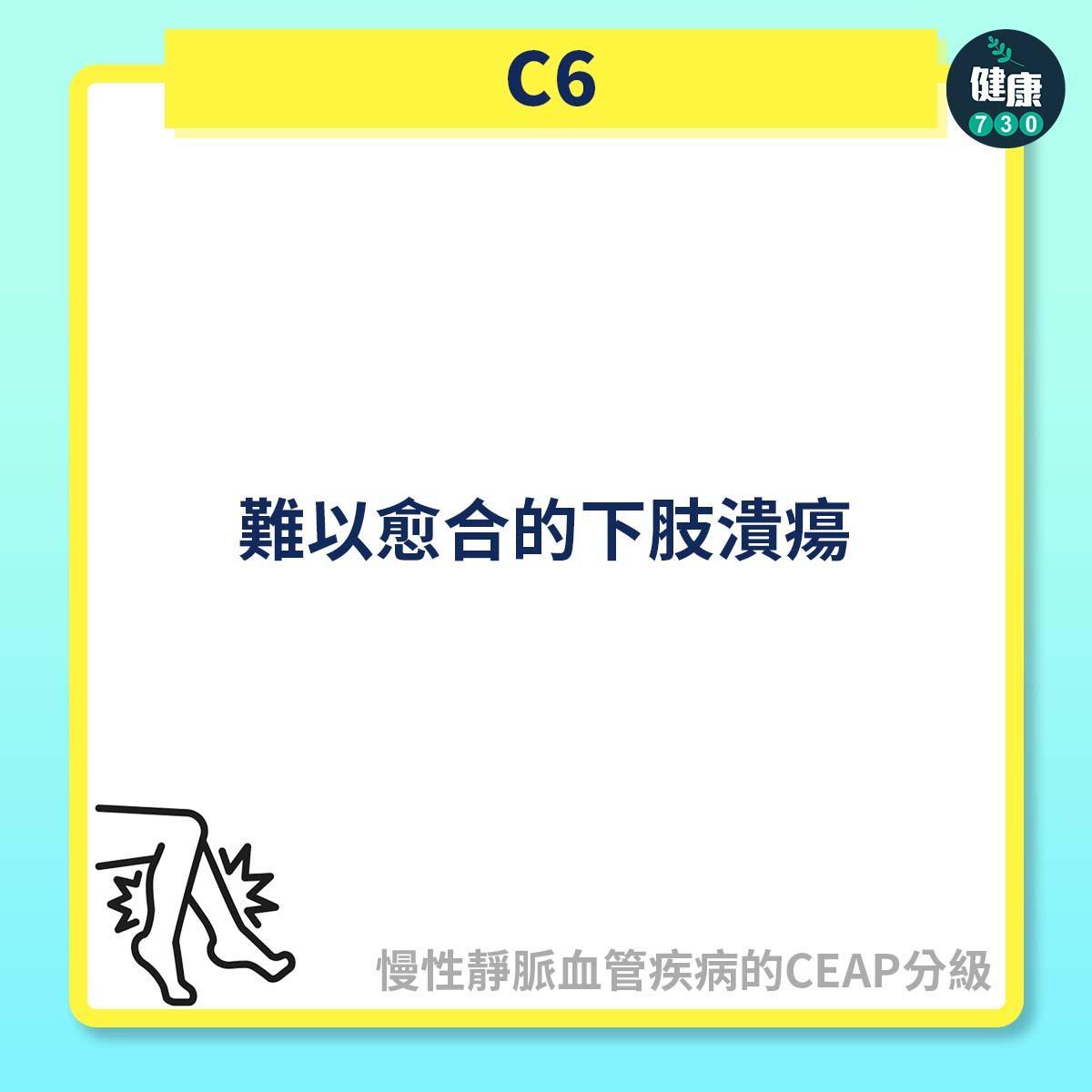 慢性靜脈血管疾病的CEAP分級,C2屬靜脈曲張(am730製圖)