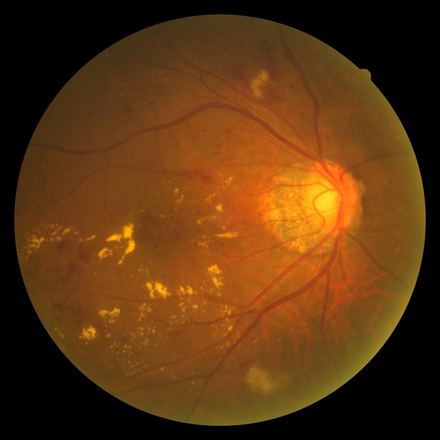 右眼糖尿病黃斑水腫。