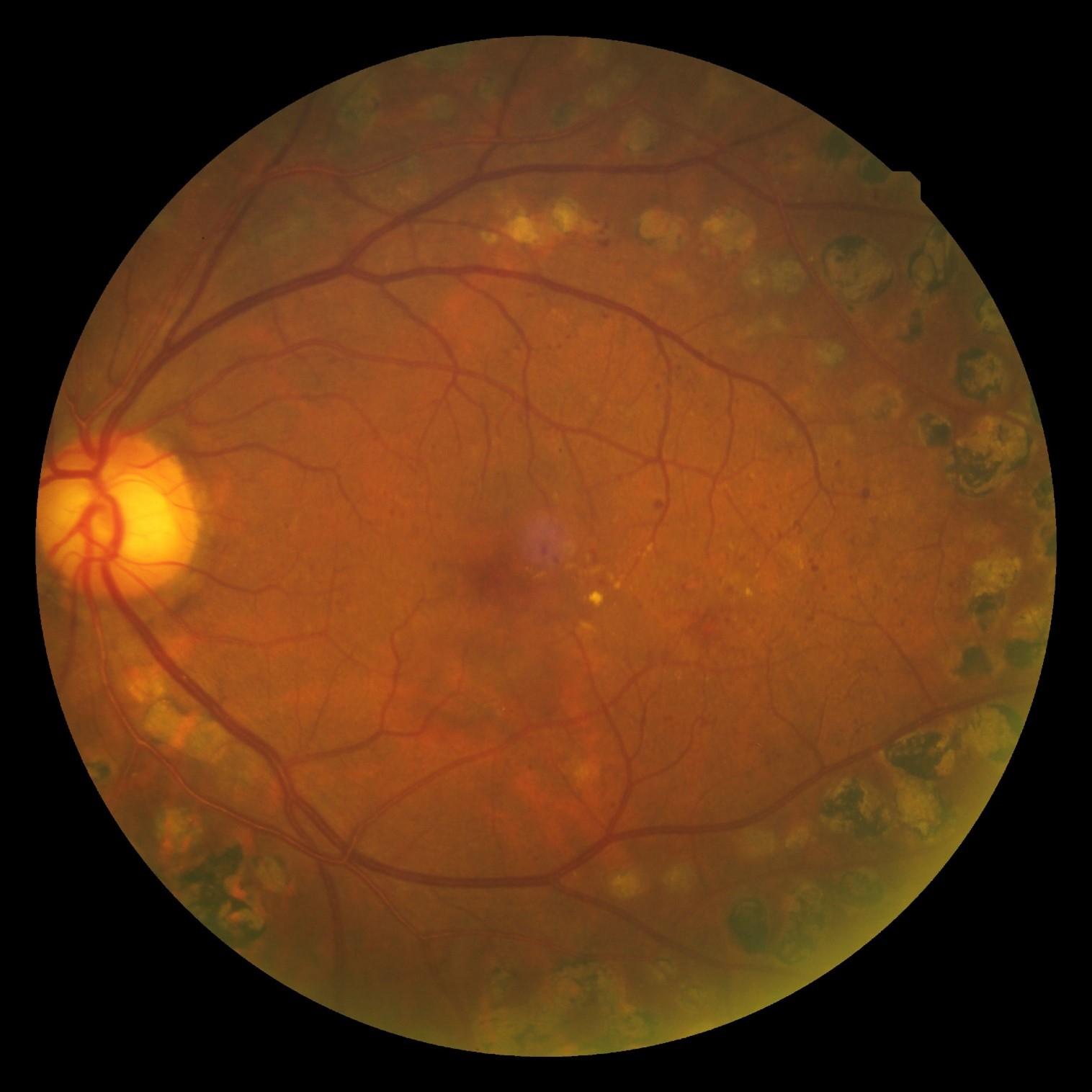 左眼全視網膜光凝激光過後的樣子。