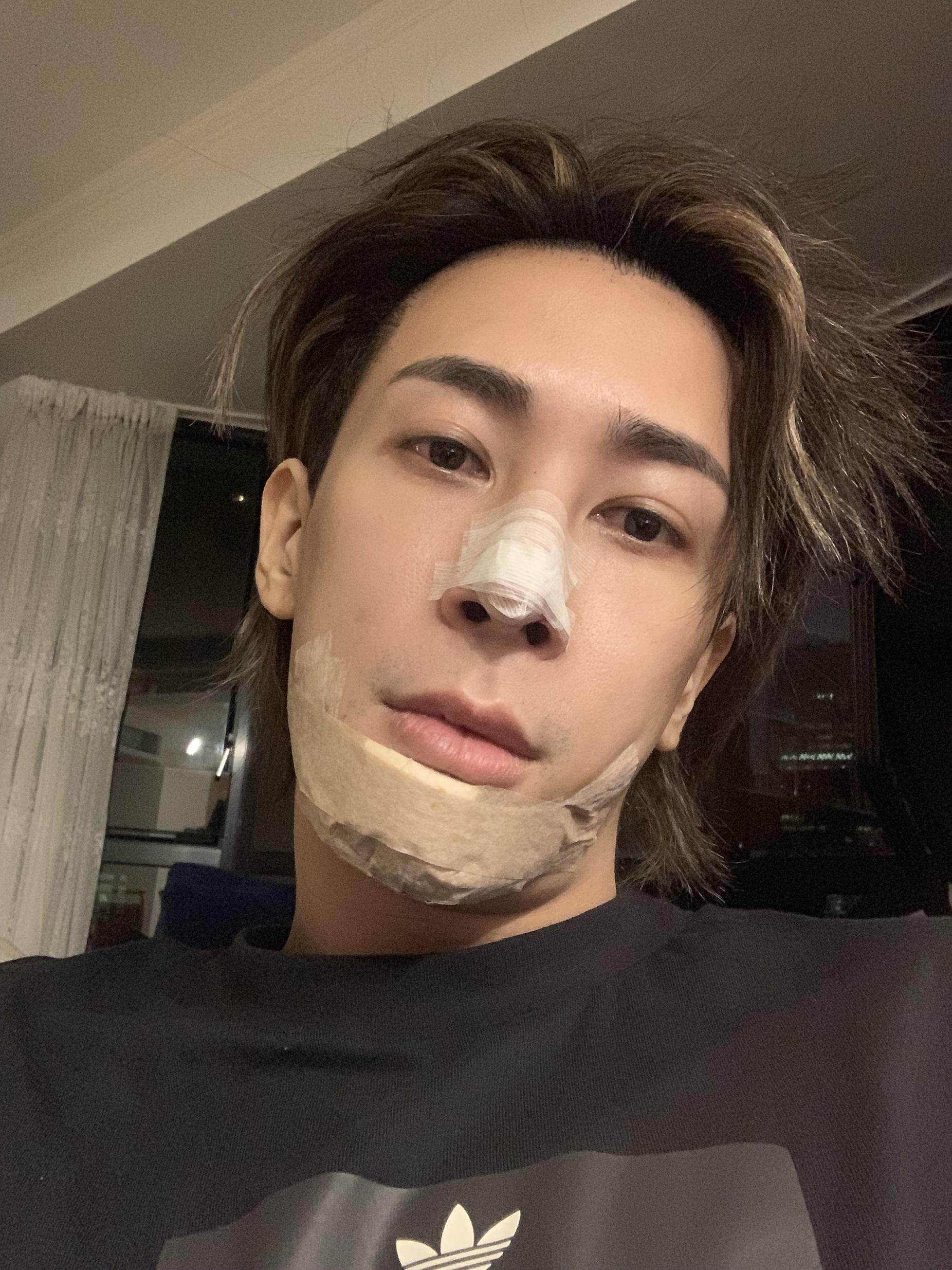 馬天佑於2019年決定清拆之前植入的鼻子和下巴假體。