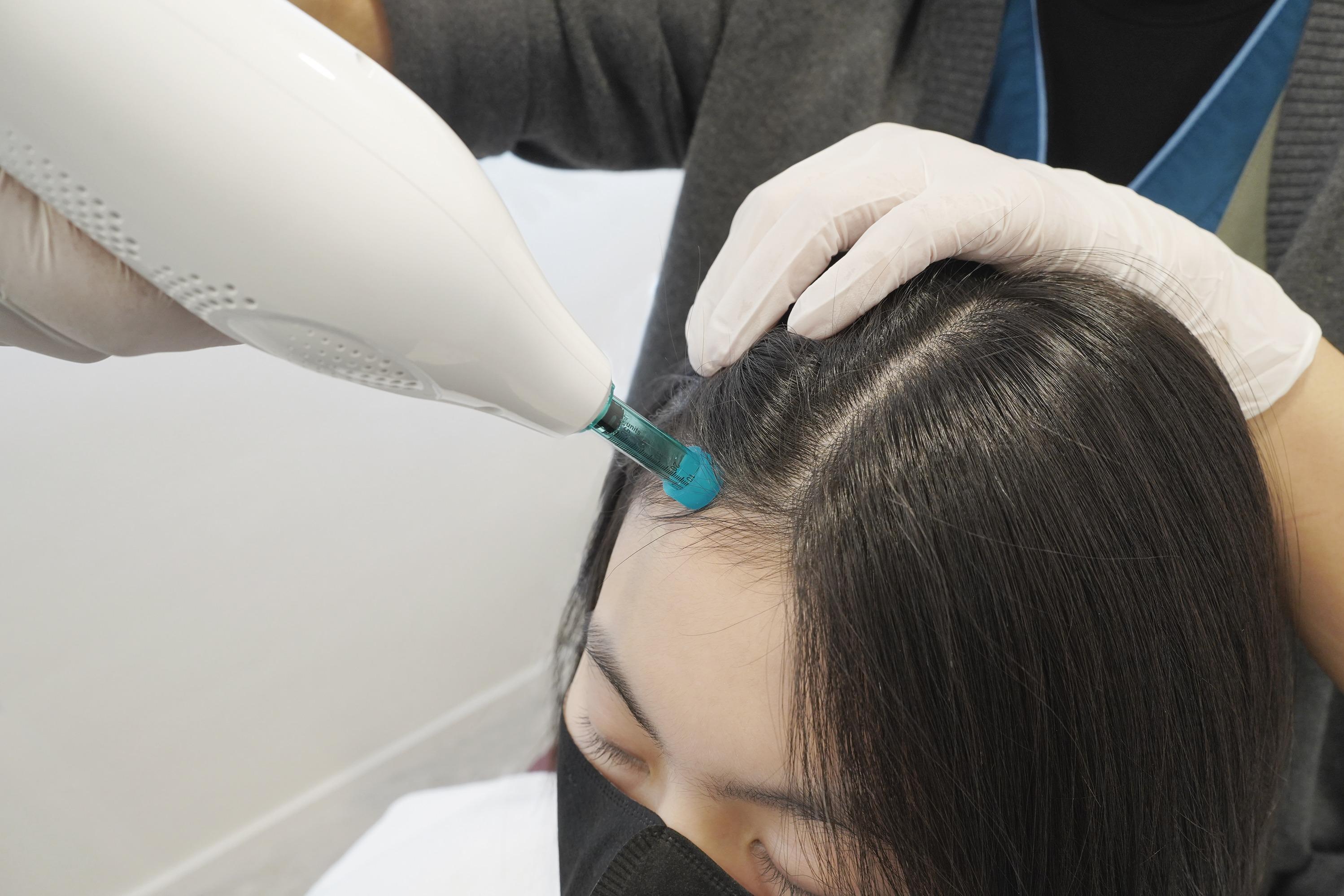 「Exo生髮槍療程」針對髮絲堅韌度及密度