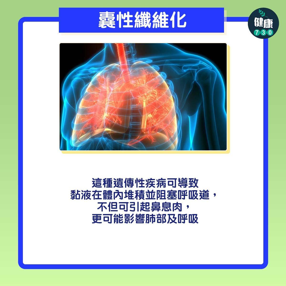 鼻塞原因|哮喘、慢性鼻竇炎、藥物敏感、過敏性鼻炎都可能是成因。(am730製圖)