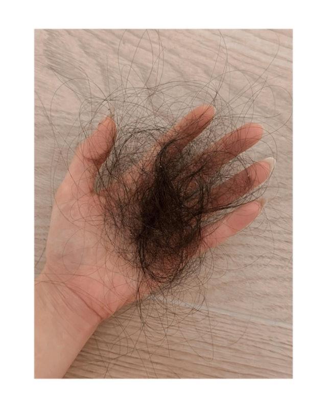 「花花」李汶靜患厭食症暴瘦,還嚴重脫髮。