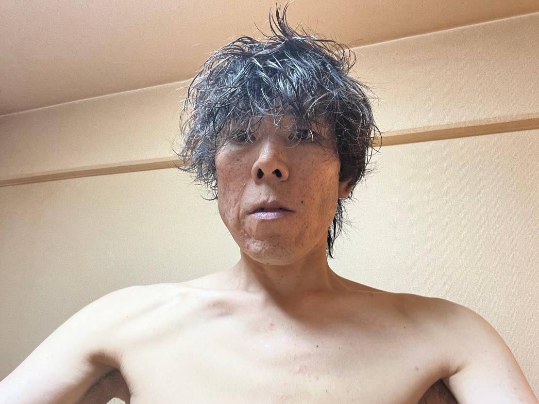 Kimbae病情嚴重,氣色欠佳。(互聯網)