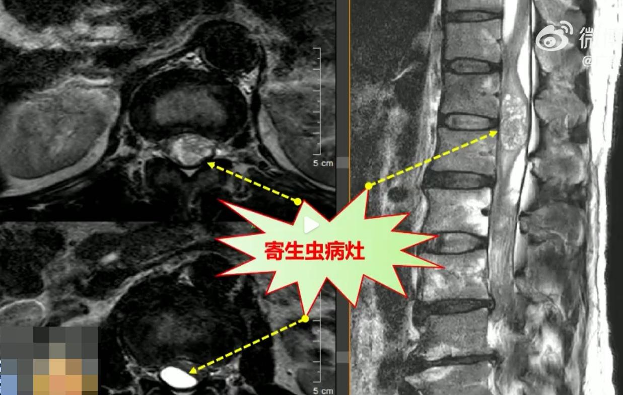 寄生蟲與脊髓神經黏連,醫院共耗時4小時才將大部分病灶清除。(微博)