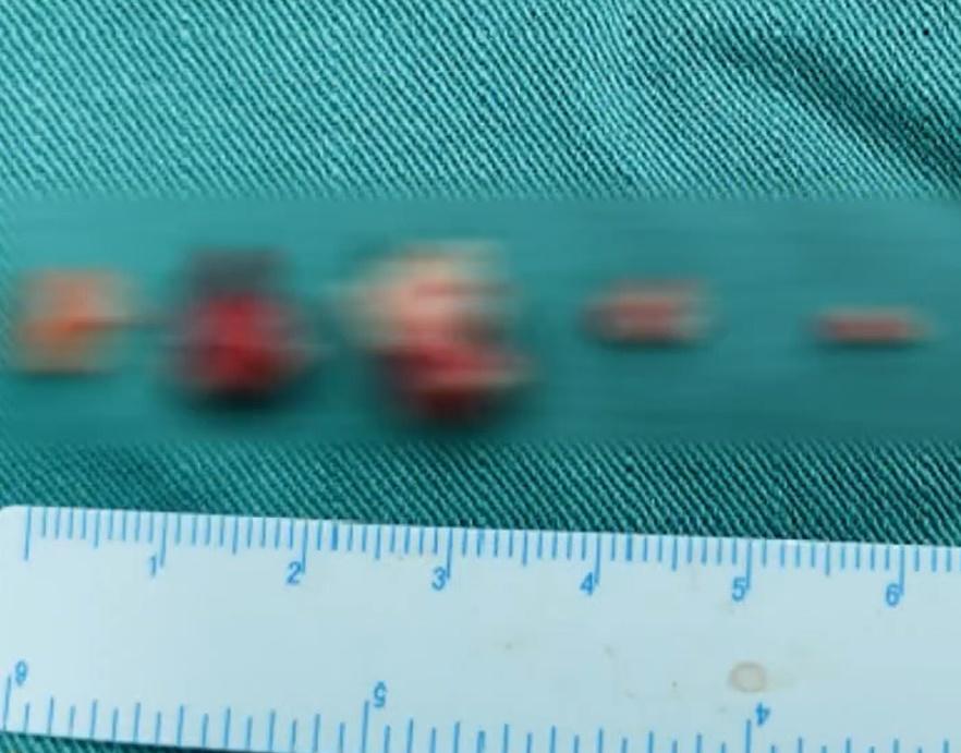 寄生蟲與脊髓神經黏連,醫院共耗時4小時才將大部分病灶清除。(微博)