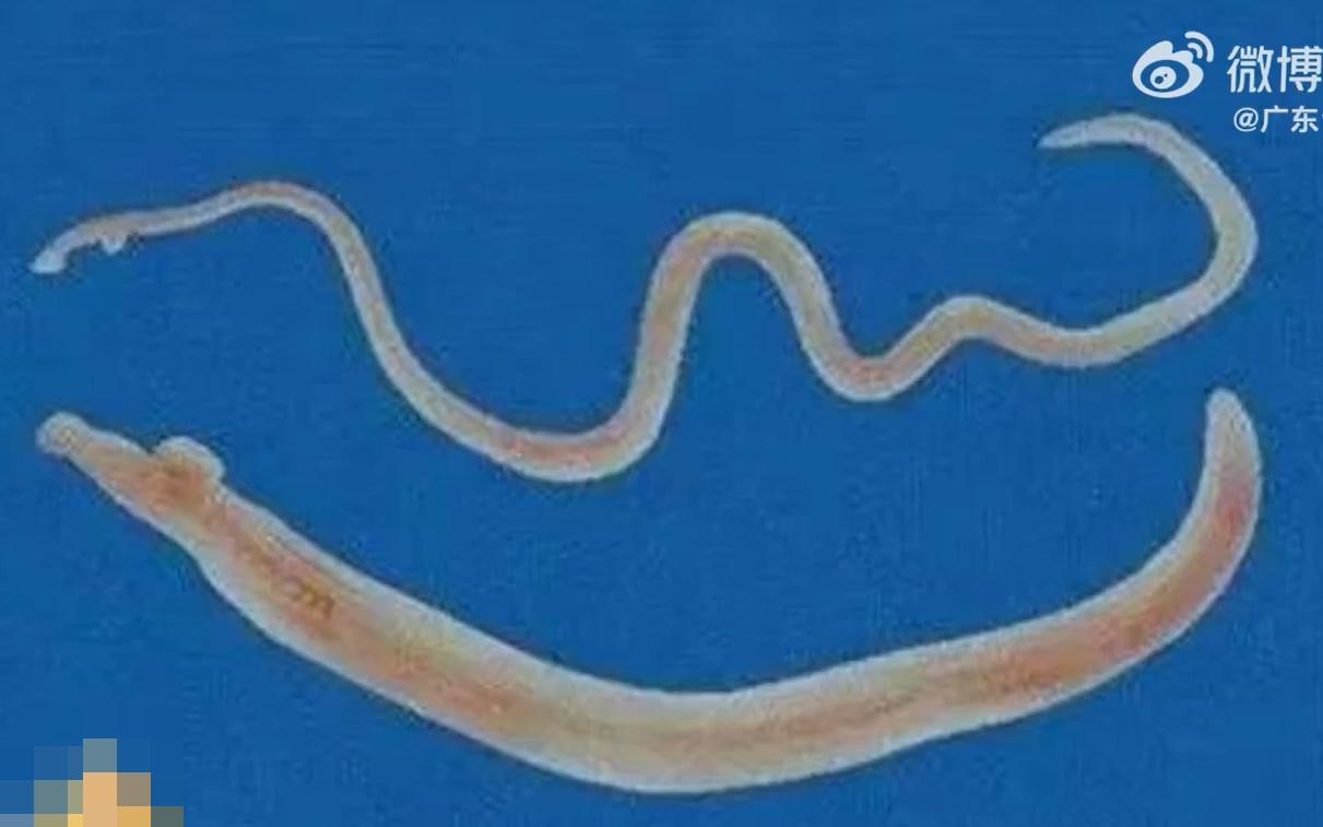 有寄生蟲長度達約6厘米,醫生:相當驚人。(微博)