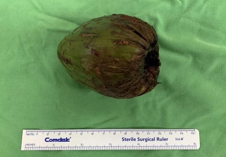 醫生評估後立即替男子動手術,以類「剖腹產」從直腸內耳出這個椰子。(網上圖片)