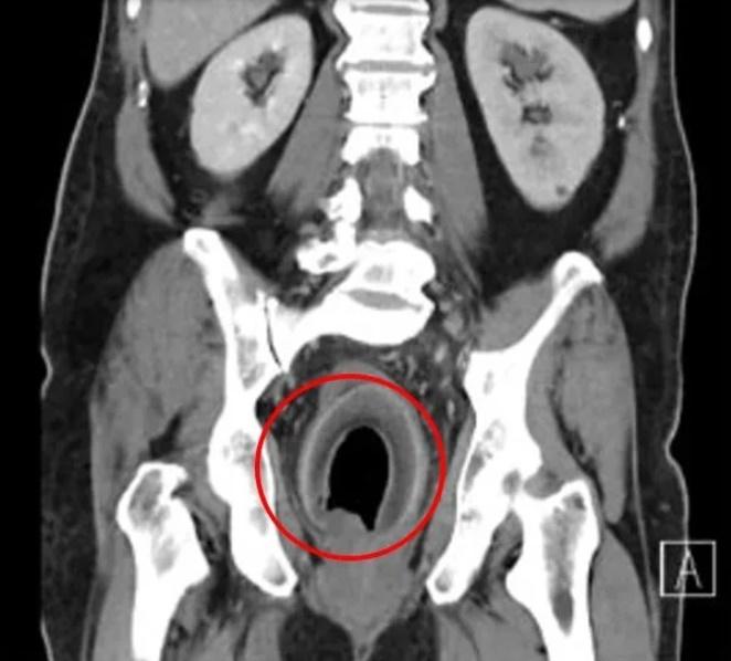CT影像中,可看到男子直腸內有一顆椰子。(網上圖片)