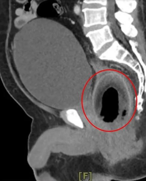 CT影像中,可看到男子直腸內有一顆椰子。(網上圖片)