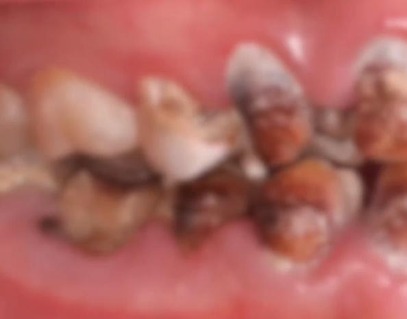 網上圖片雖然已作模糊處理,仍可見女事主一整排牙齒因遭嚴重腐蝕變得又啡又黑,十分駭人。(微博)