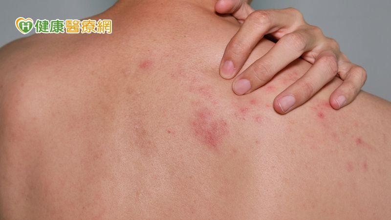 5旬男吃感冒藥皮膚剝落糜爛 禍首竟是兩周前服用的藥物