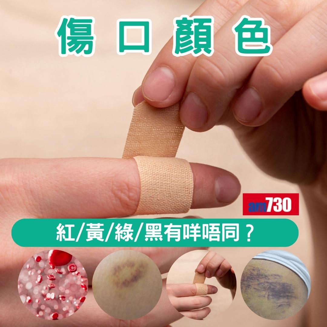 傷口顏色|紅黃綠黑有咩唔同?小心處理加速癒合時間(am730製圖)