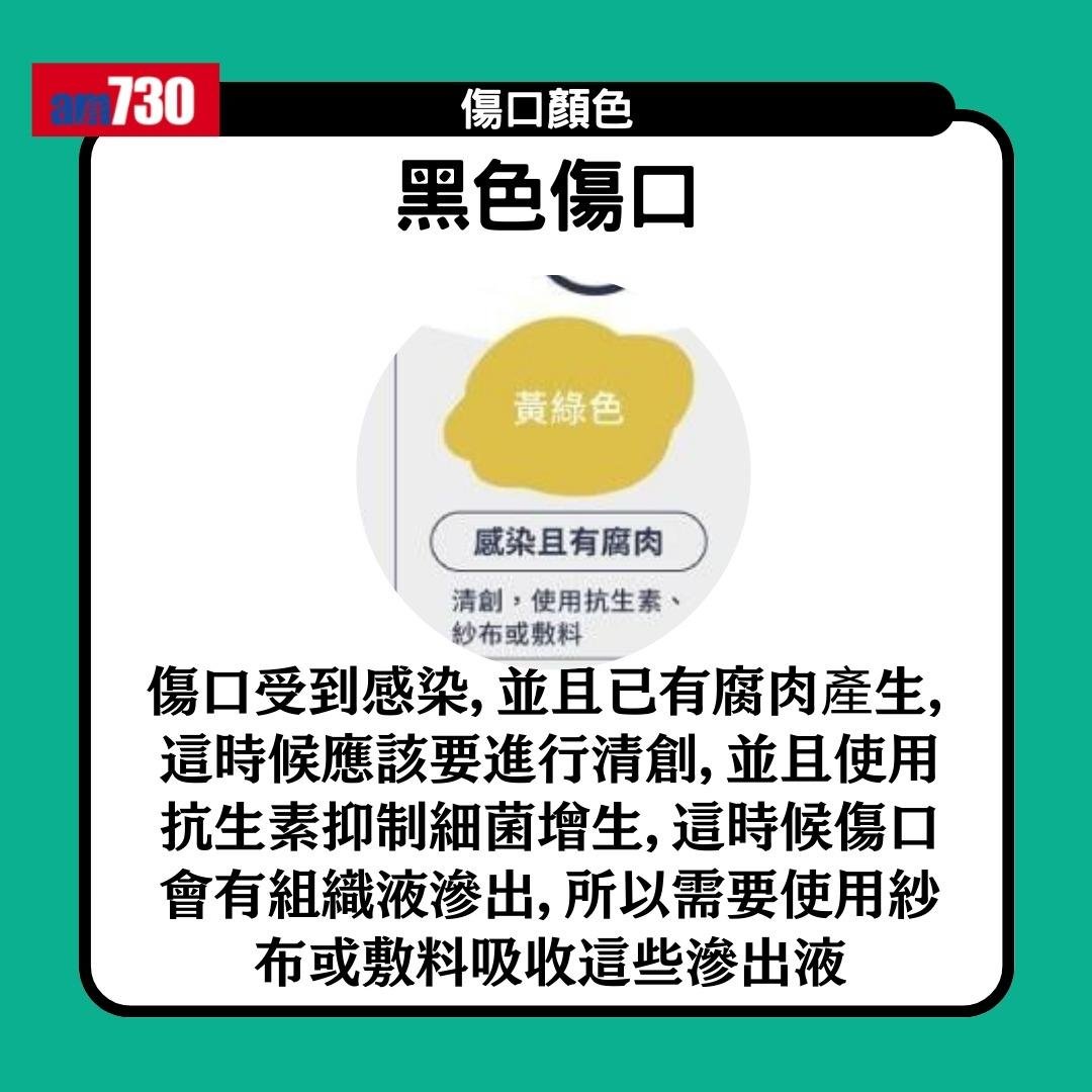 傷口顏色|紅黃綠黑有咩唔同?小心處理加速癒合時間(am730製圖)