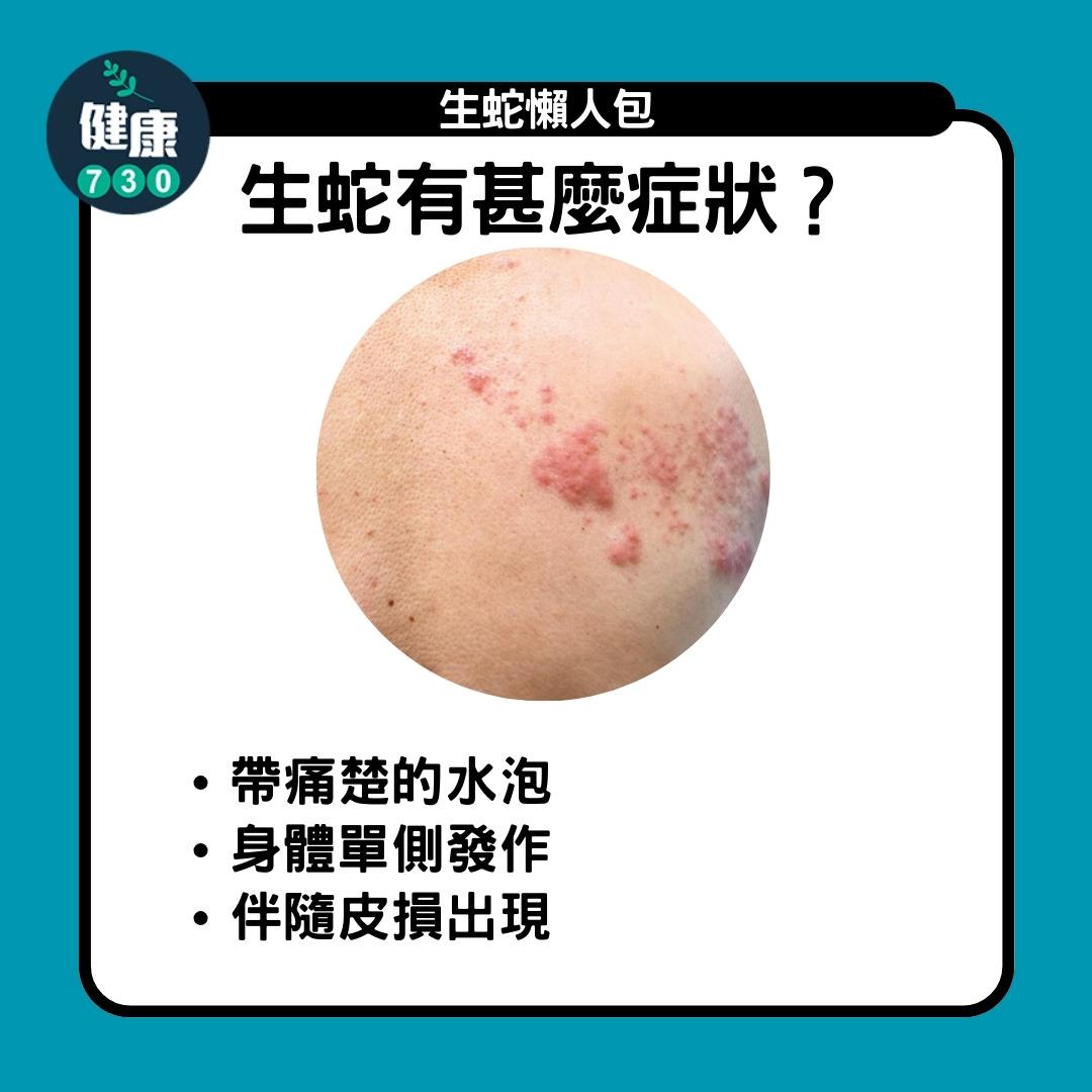 生蛇懶人包,生蛇有甚麼症狀(am730製圖)