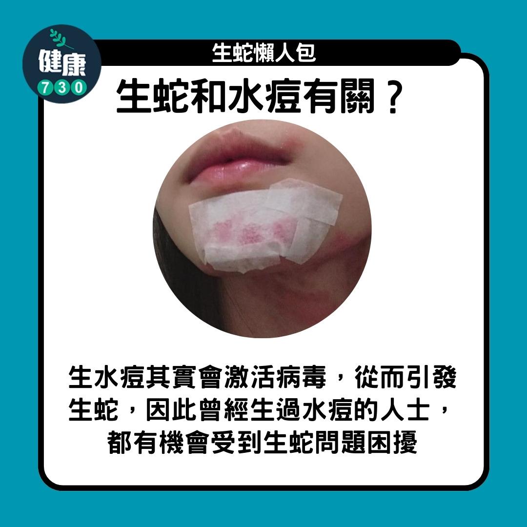 生蛇懶人包,生蛇和水痘有關?(am730製圖)