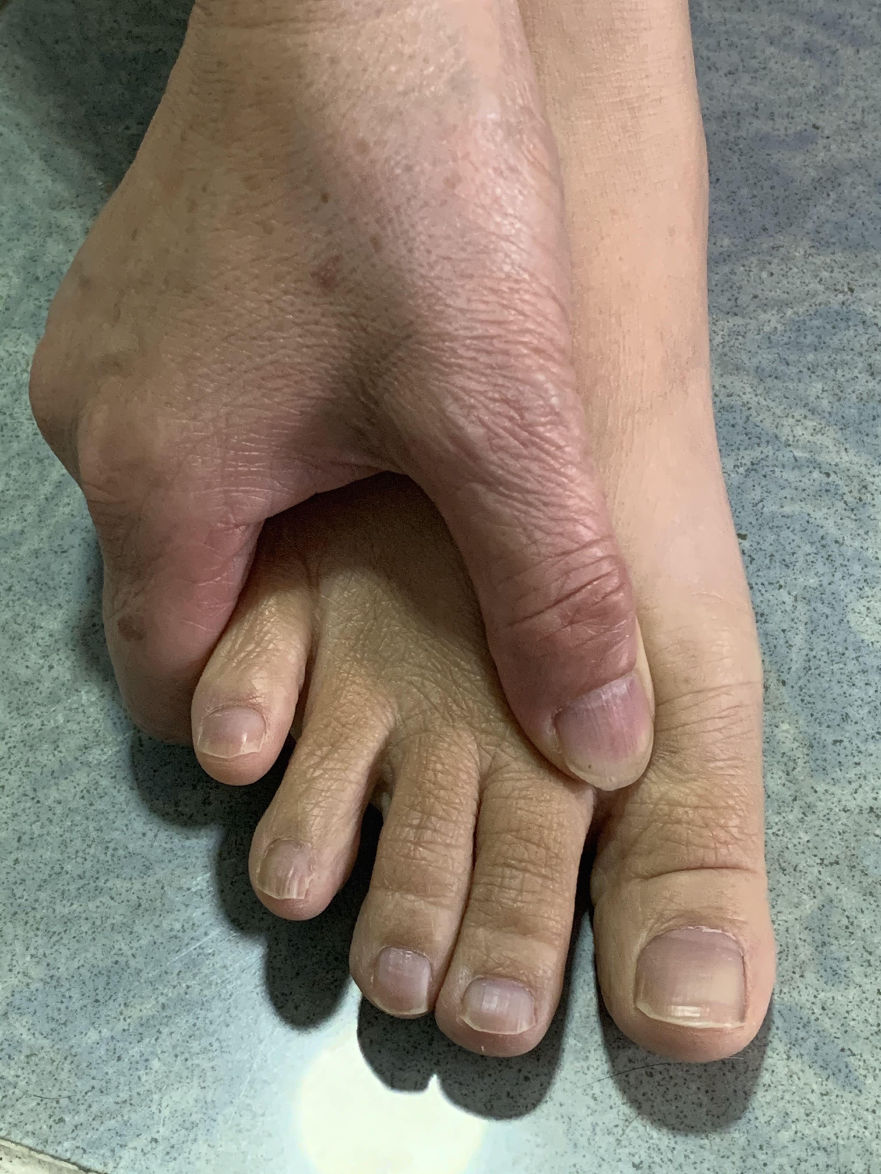 行間穴在姆指與食趾(第二根腳趾)中間,有助疏肝理氣。