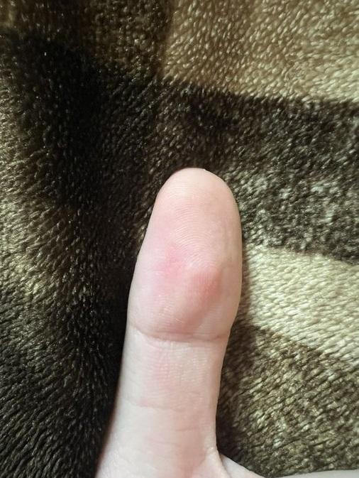 樓主事後上傳手指回復正常的照片。(互聯網)