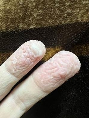 手指頭浸到滿是深刻的皺褶,看來就像腦袋褶紋,還有少許脫皮。(互聯網)