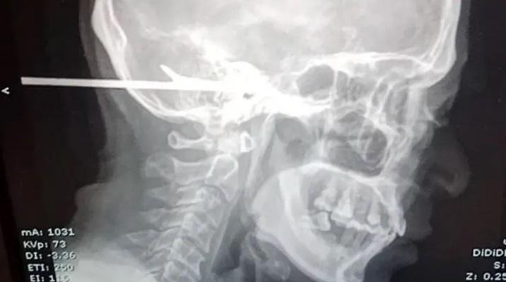 X光檢查顯示,魚叉貫穿耳部插進蘇吉特的後腦。(互聯網)