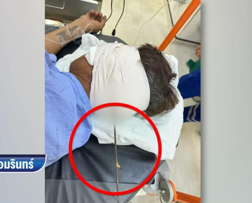 蘇吉特送院時,後腦插著魚叉。(互聯網)