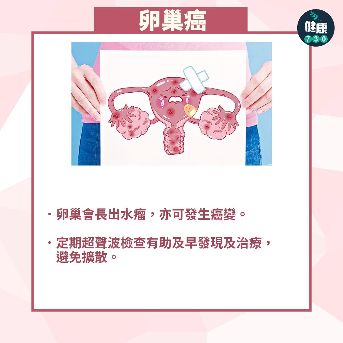 常見婦科疾病|卵巢癌(am730製圖)