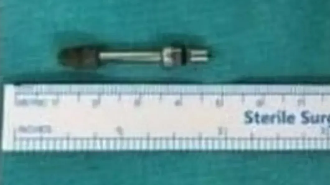 醫生從他的大腦取出那口螺絲。(網上圖片)